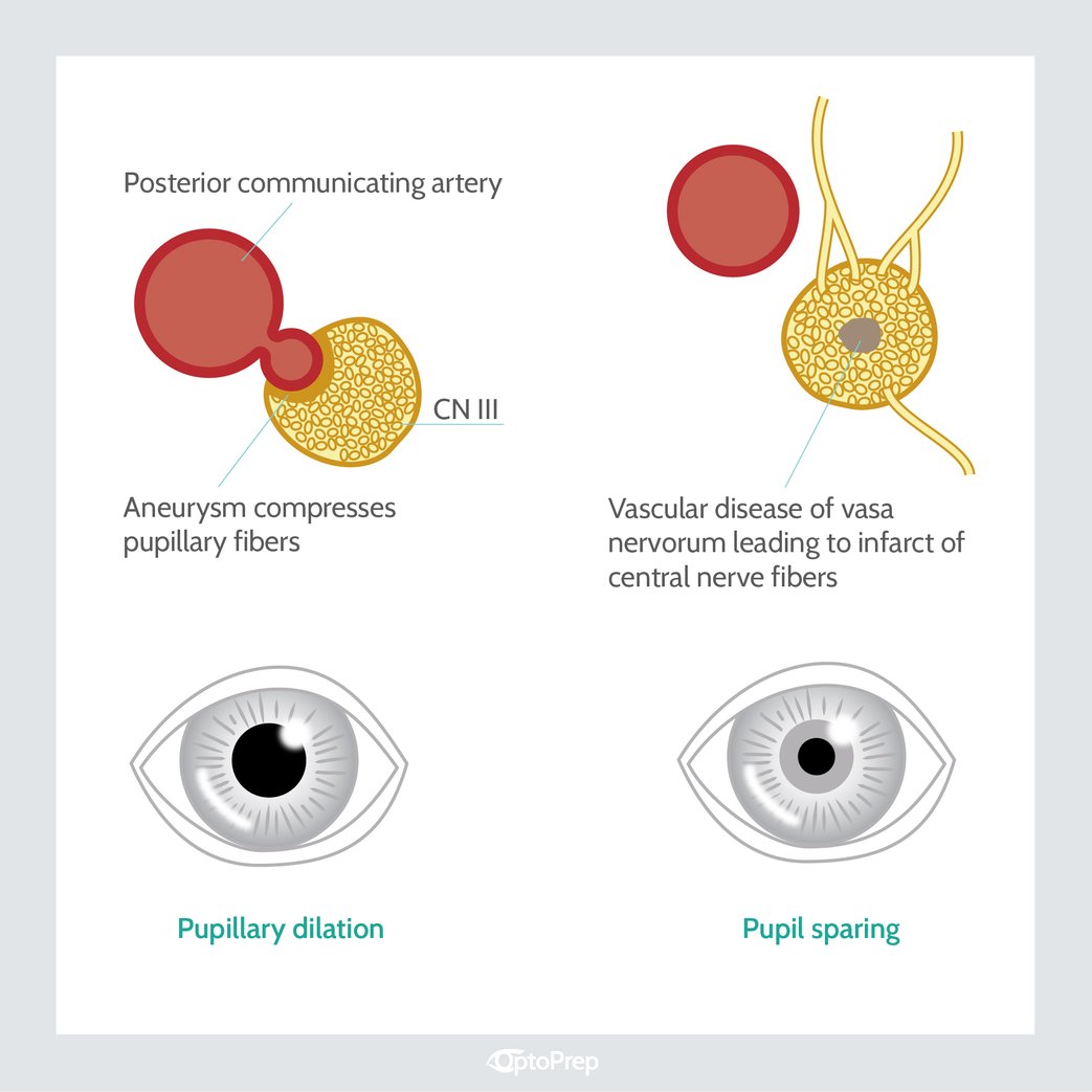 Pupil-Involved vs. Pupil-Sparing Acquired Oculomotor Nerve Palsy